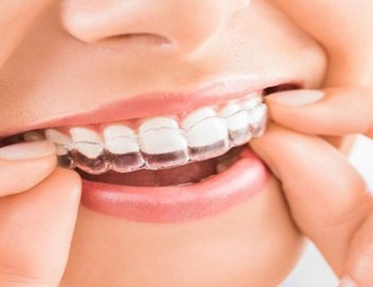 clear-aligners-treatment